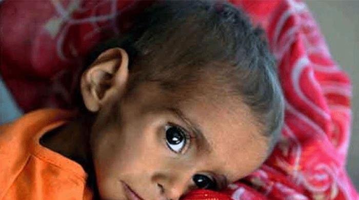 Malnutrition takes 10 more lives in Thar