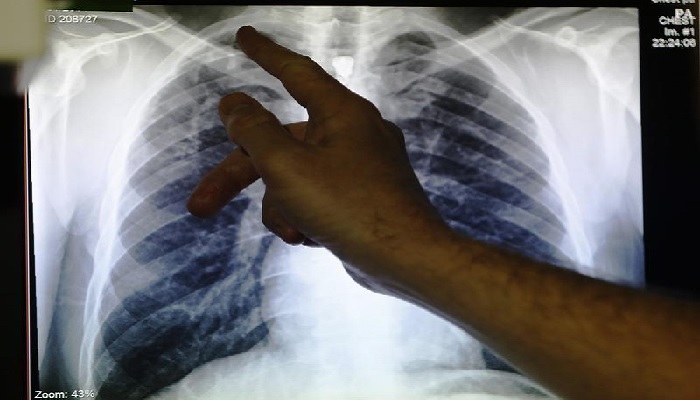 Clinical lead Doctor Al Story points to an x-ray showing a pair of lungs infected with TB (tuberculosis) during an interview with Reuters on board the mobile X-ray unit screening for TB in Ladbroke Grove in London January 27, 2014. &mdash;Reuters