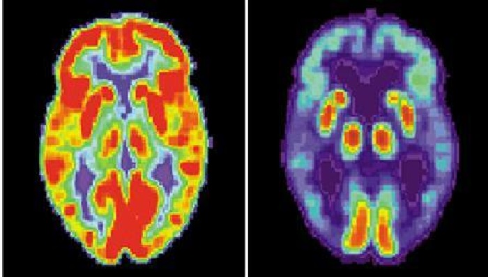 A split-view image showing PET scans of a normal brain (L) and a brain with Alzheimers disease. &mdash;Reuters