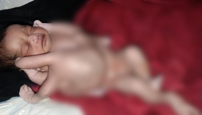 The picture shows a baby born with multiple limbs. &mdash; India Today