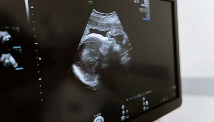 33 women receive uterus transplants in the US.&mdash; Pexel