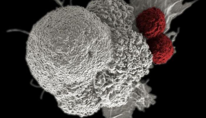 An oral squamous cancer cell (white) being attacked by two cytotoxic T cells (red), part of a natural immune response. &mdash; Reuters