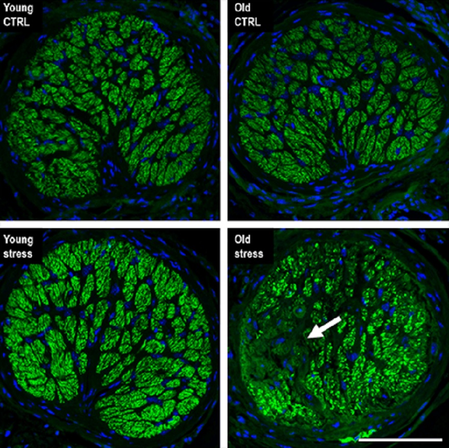 When the UCI-led team examined the optic nerve head of eyes that had minor pressure elevation, they discovered that there was no evidence of axon loss in the juvenile optic nerve head. However, a considerable sectorial loss of axons was found in the optic nerves of aged animals, which is similar to the phenotype frequently seen in glaucoma patients.— UCI School of Medicine