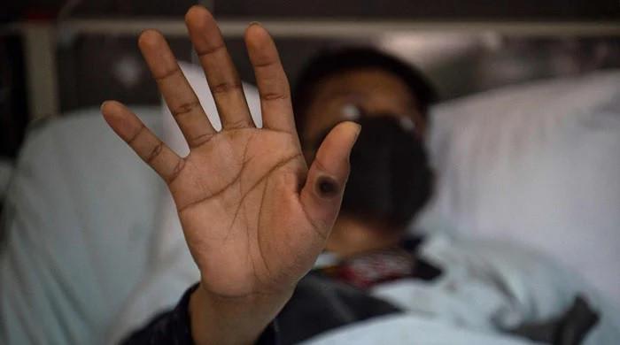 Karachi reports first confirmed mpox case; health officials on alert
