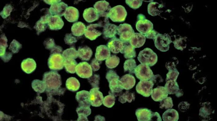 Naegleria claims another life in Karachi, toll hits five in Sindh
