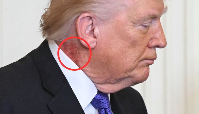 Trumps neck rash sparks fresh health questions