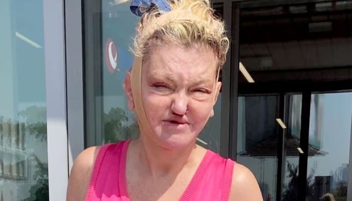 Danniella Westbrook has previously undergone various reconstructive operations in a bid to fix her collapsing face