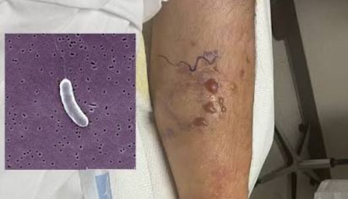 What is Vibrio Vulnificus? Flesh eating bacteria spreading in Gulf waters that has killed 5
