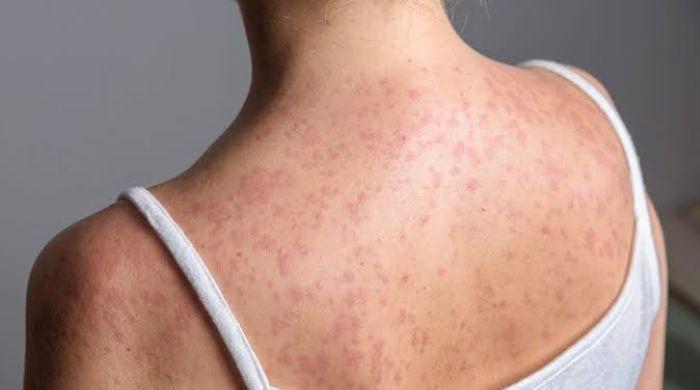 Who are two people who died of Measles in Pennsylvania? What we know