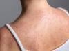 Who are two people who died of Measles in Pennsylvania? What we know