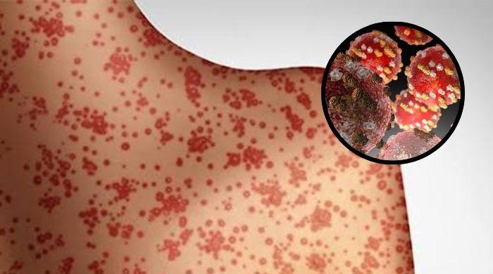 Which US states are at highest risk of measles in 2026? Full details about active outbreak