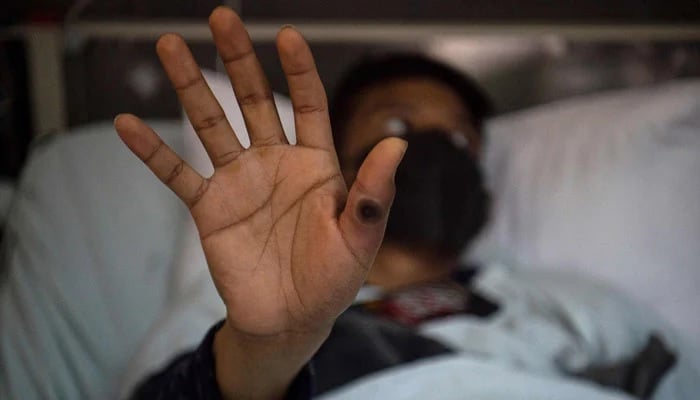 This photo, taken on August 16, 2022, shows a patient with a sore on his hand caused by mpox, in the isolation area for mpox patients at the Arzobispo Loayza hospital in Lima, Peru. — AFP